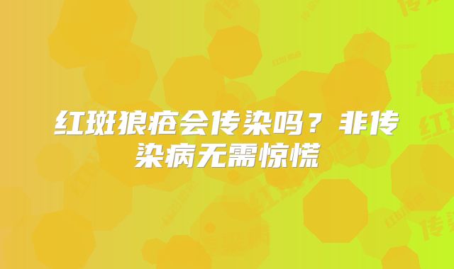 红斑狼疮会传染吗?非传染病无需惊慌