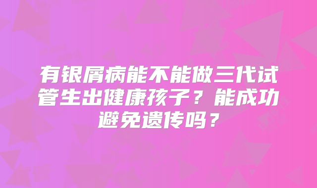 有银屑病能不能做三代试管生出健康孩子？能成功避免遗传吗？